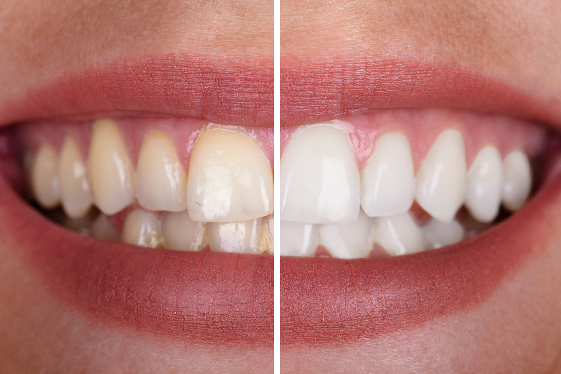 Teeth Whitening in Poole