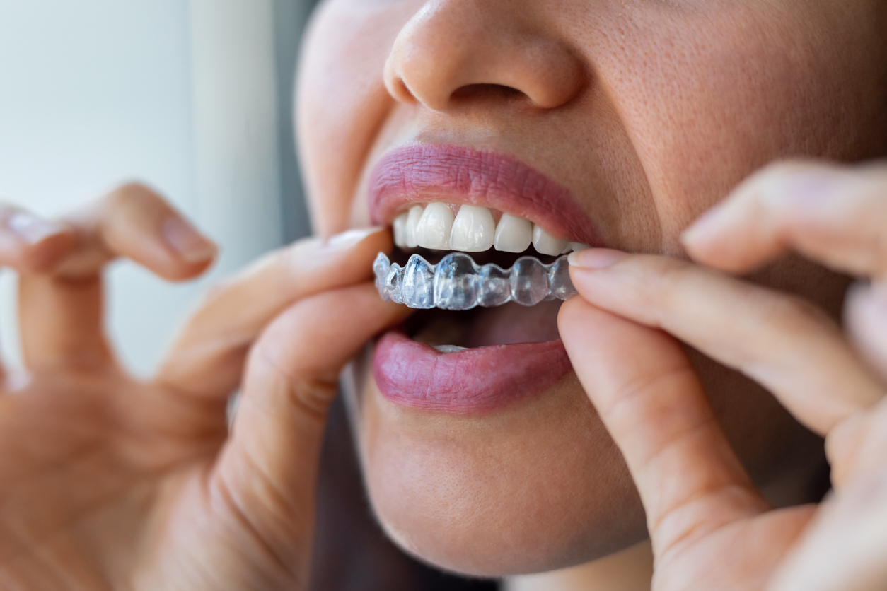 Invisalign